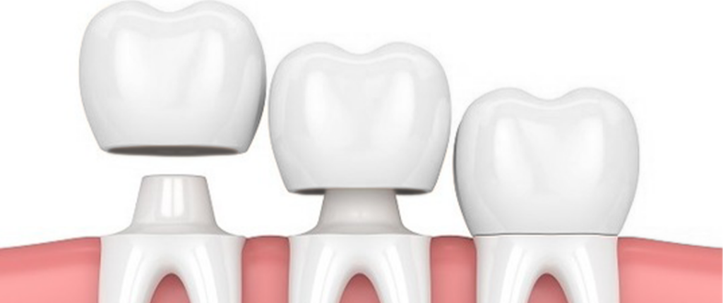 Коронка на зуб из металлокерамики
